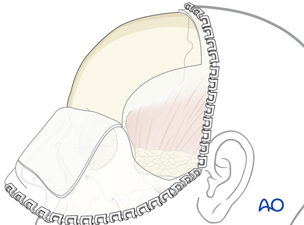 Coronal approach