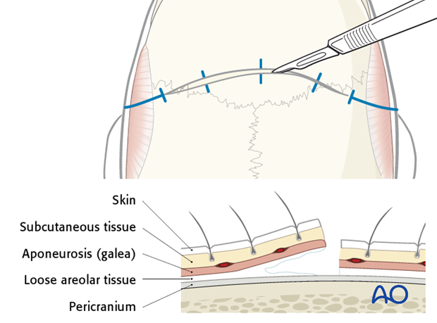 Coronal approach - incision