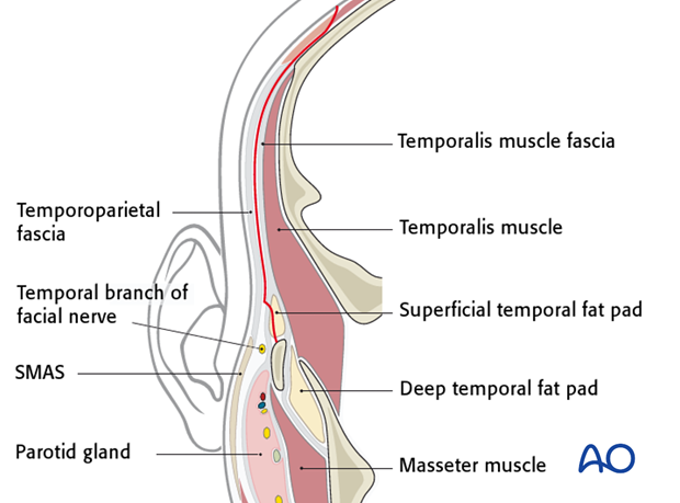 Incision of the superficial temporal fascia for exposure of the zygomatic arch 