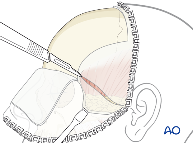 Incision of the superficial temporal fascia for exposure of the zygomatic arch 