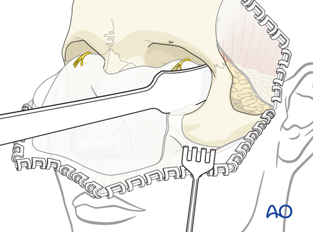 Subperiosteal Exposure of the orbits and upper midface