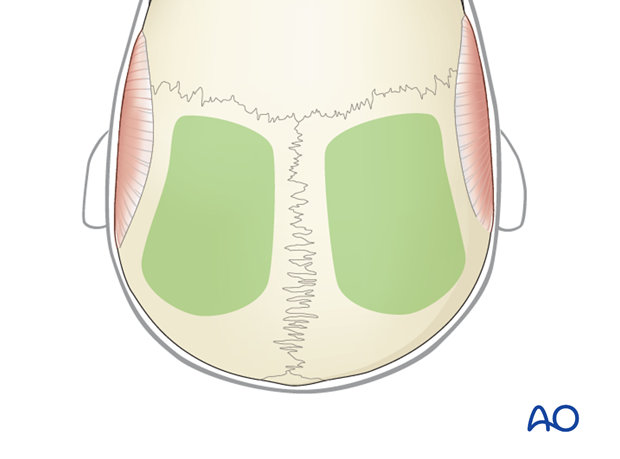 Harvesting cranial bone grafts