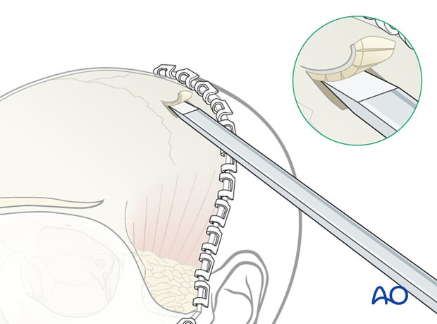 Harvesting cranial bone grafts