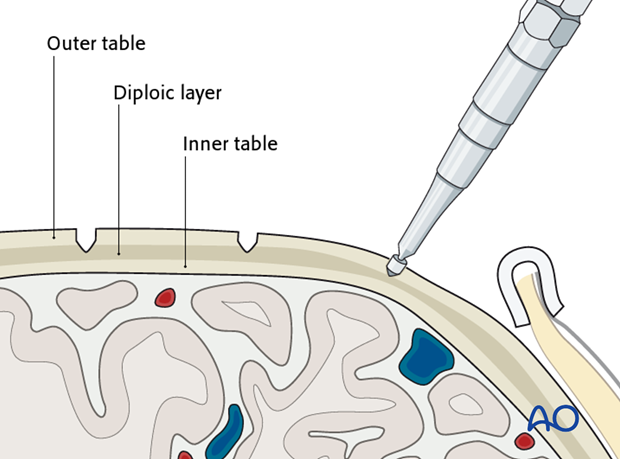 Harvesting cranial bone grafts