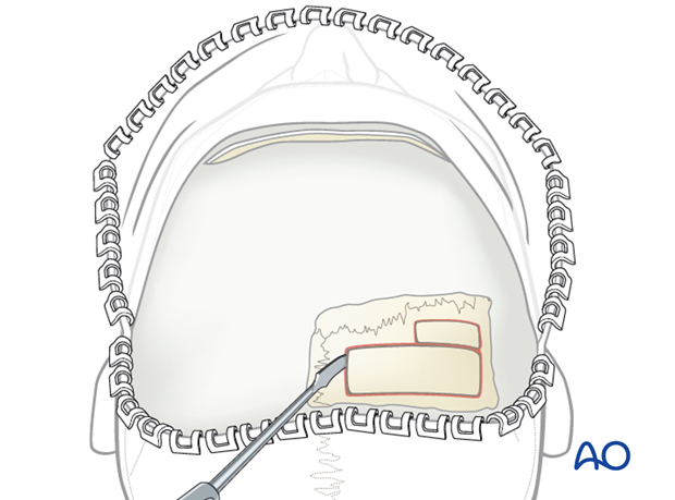 Harvesting cranial bone grafts