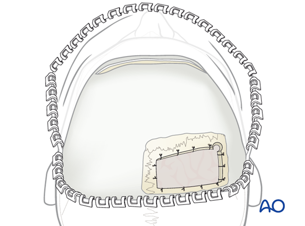 Harvesting cranial bone grafts