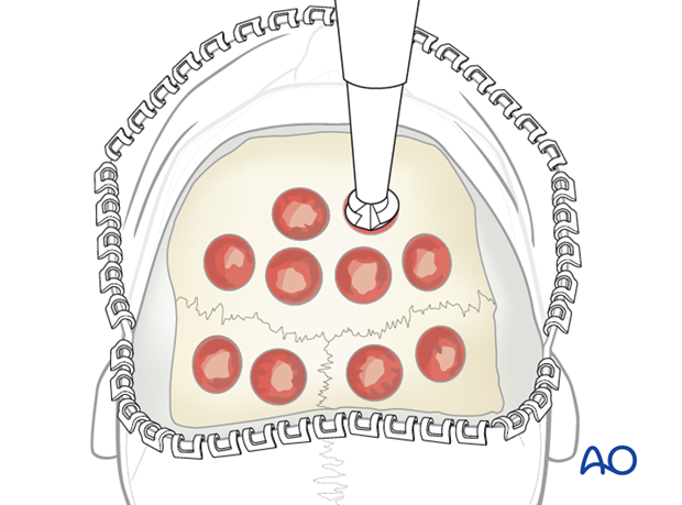 Harvesting cranial bone grafts