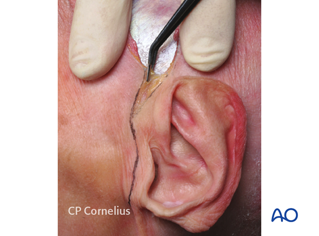 Coronal approach - incision