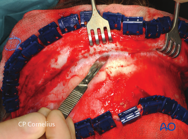 Coronal flap elevation