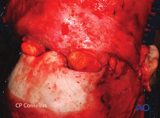 Elevation of the coronal flap