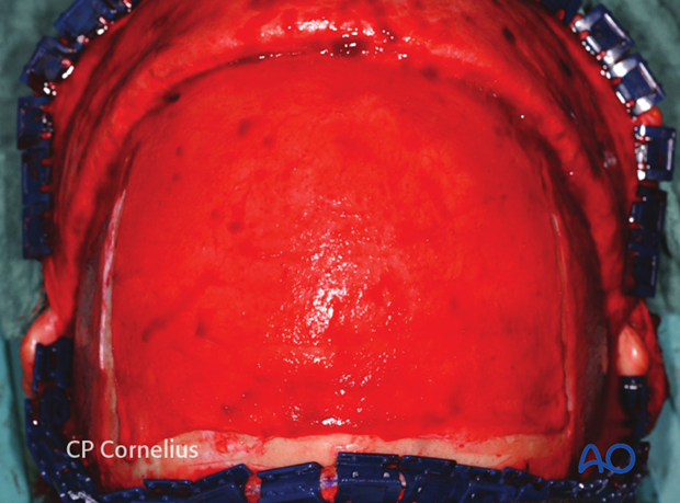 Bilaterally incisions along the superior temporal lines from the anterior to posterior extent of the exposed surface