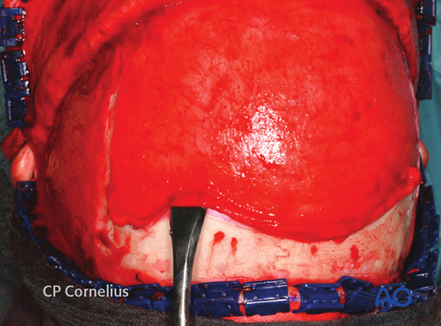 Elevation of the pericranial flap