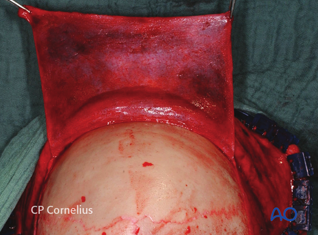 Development of pericranial flap