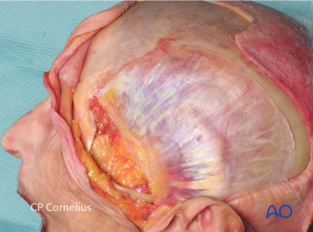 Incision of the superficial temporal fascia for exposure of the zygomatic arch 