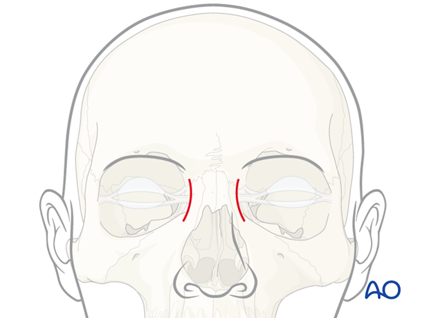 approaches not generally recommended