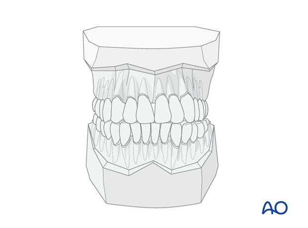 panfacial fractures sequencing of repair