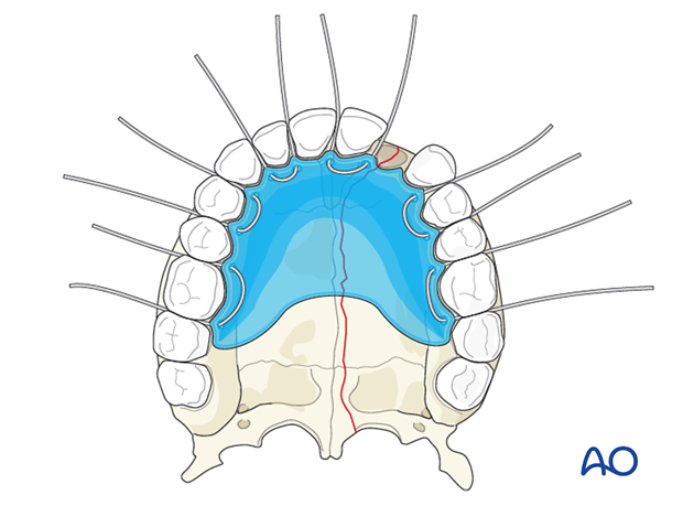 panfacial fractures sequencing of repair