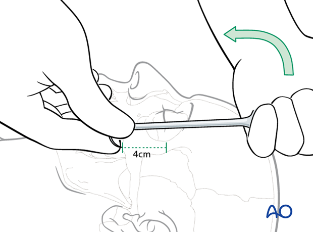 open reduction internal fixation