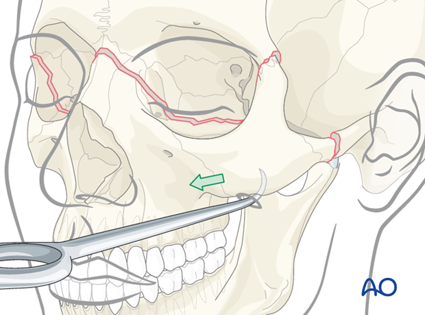 open reduction internal fixation