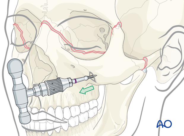 open reduction internal fixation