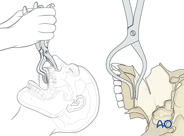 open reduction internal fixation