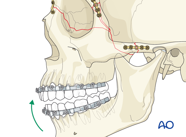 open reduction internal fixation