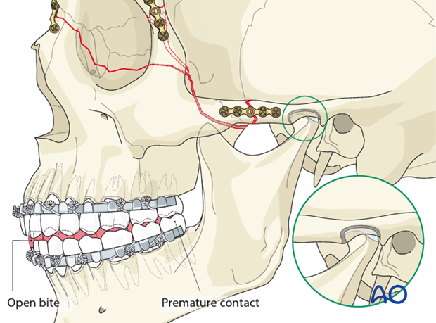 open reduction internal fixation