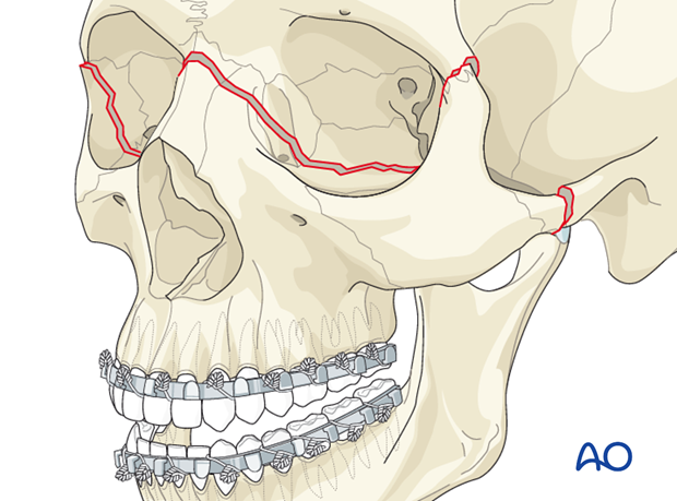 open reduction internal fixation