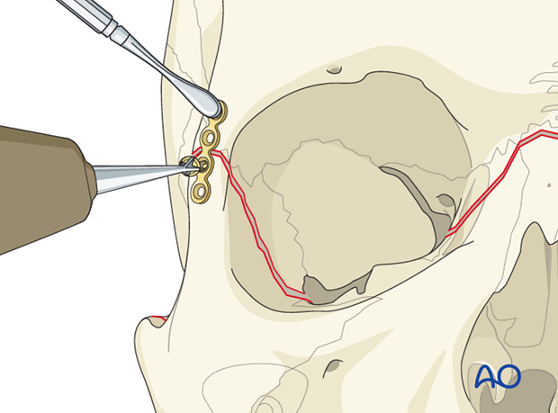 open reduction internal fixation