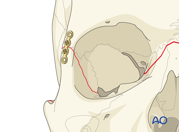 open reduction internal fixation