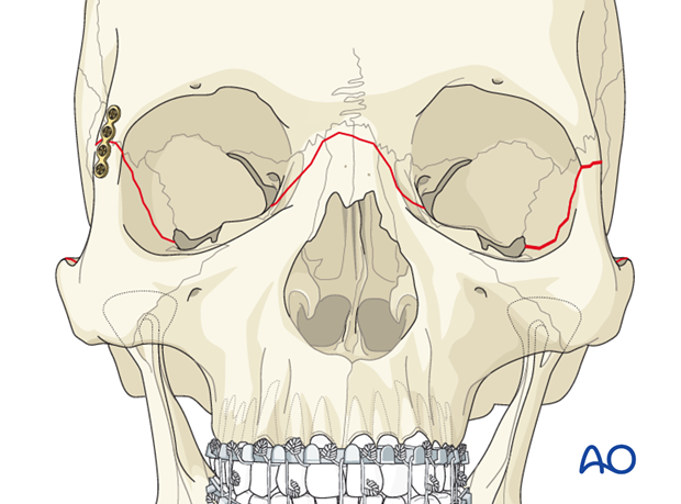 open reduction internal fixation