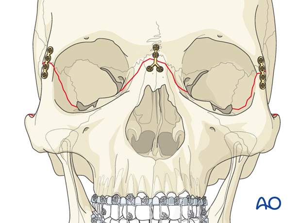 open reduction internal fixation