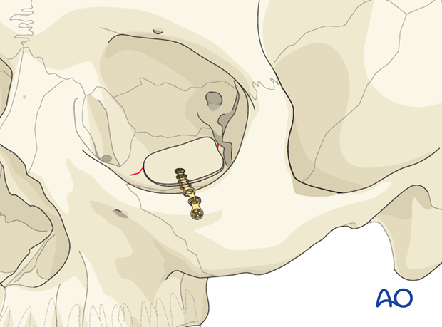 orbital reconstruction