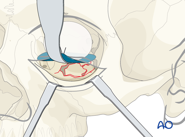 orbital reconstruction