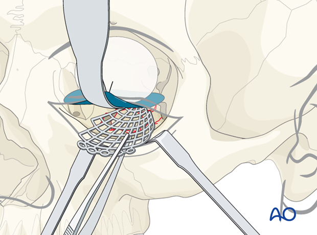 orbital reconstruction