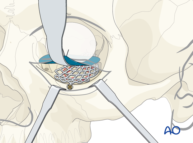 orbital reconstruction