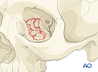 combined medial wall and orbital floor fractures