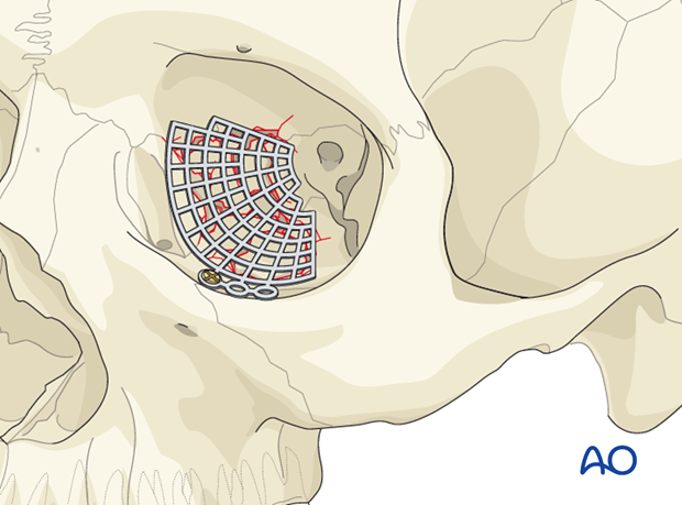 orbital reconstruction