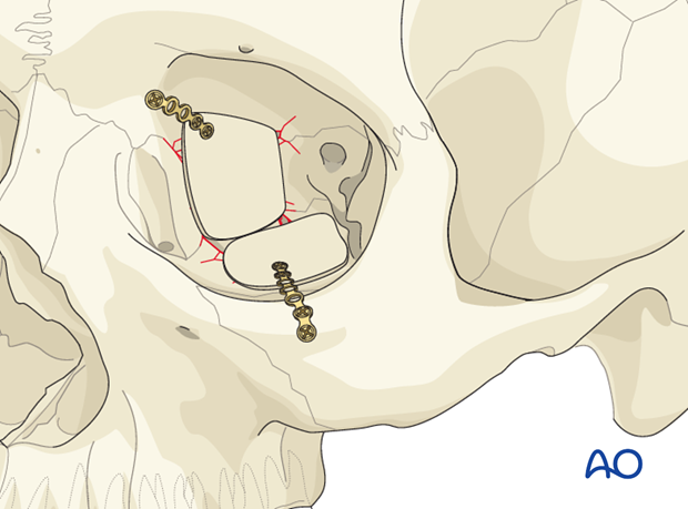 orbital reconstruction