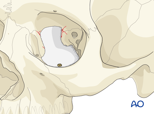 orbital reconstruction