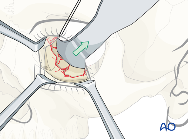 orbital reconstruction