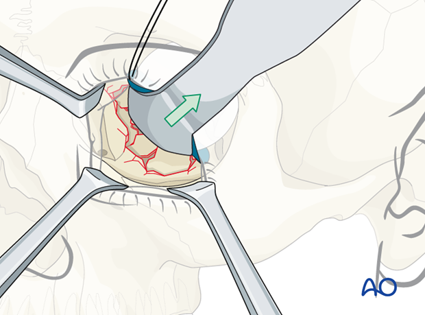 orbital reconstruction