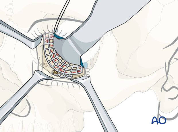 orbital reconstruction