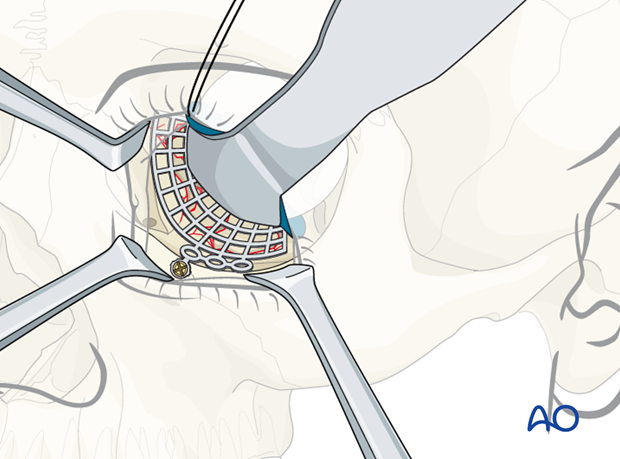 orbital reconstruction