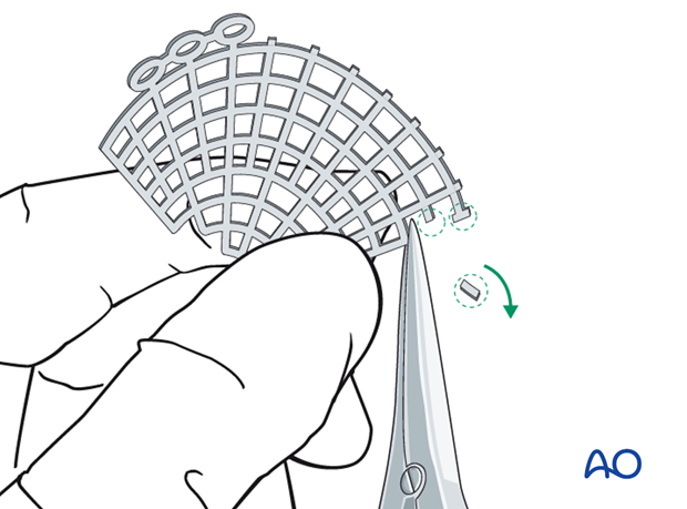 reconstruction of orbital floor wall defects