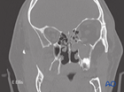 combined medial wall and orbital floor fractures