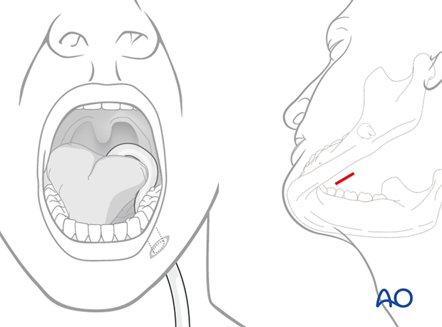 Airway considerations