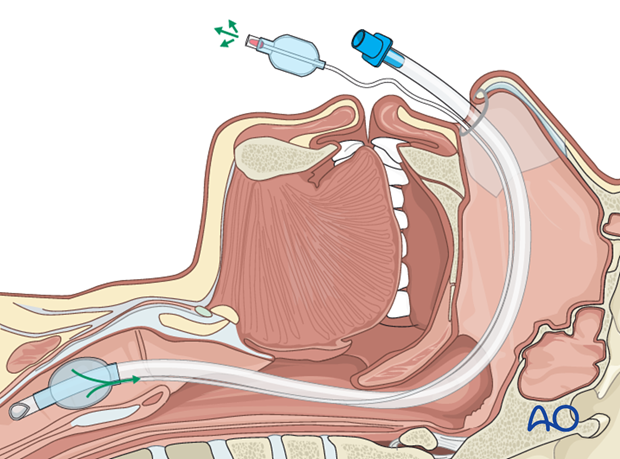 Airway considerations