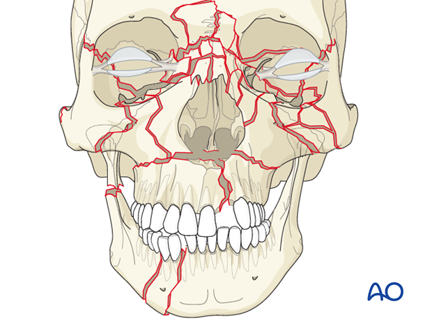 panfacial fractures sequencing of repair