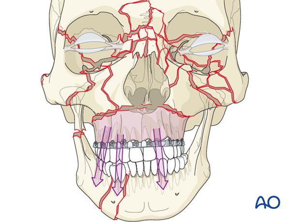 panfacial fractures sequencing of repair